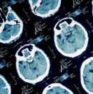 Traumatic Brain Injury and ET - Sperling Neurosurgery Associates