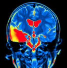 Brain MRI - Sperling Neurosurgery Associates